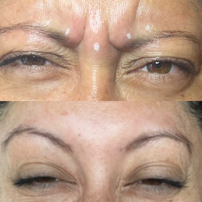 botox, wrinkles