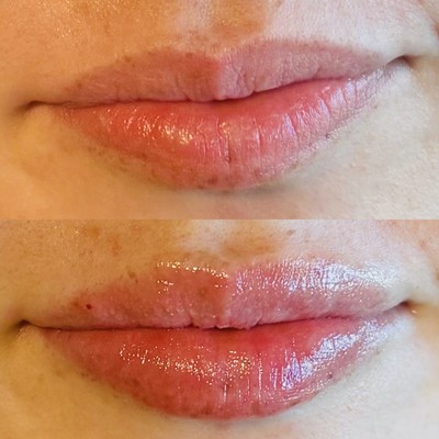 lip filler